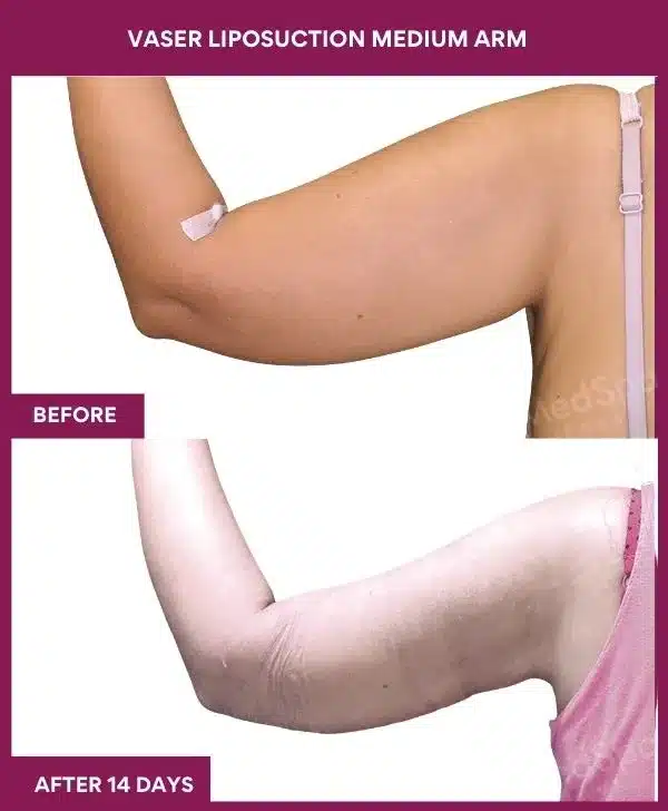 3 VASER LIPOSUCTION MEDIUM ARM- (2)