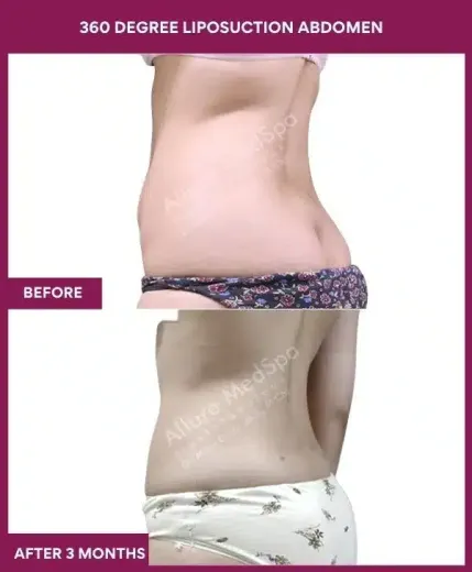 4- 360 DEGREE LIPOSUCTION ABDOMEN-