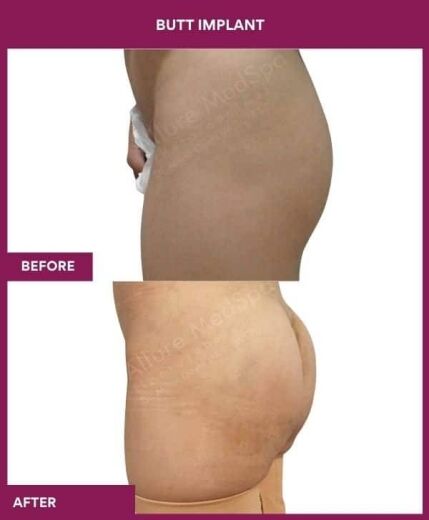 4 BUTT IMPLANT in Mumbai, India