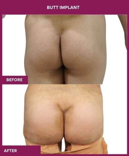 4 BUTT IMPLANT in Mumbai, India