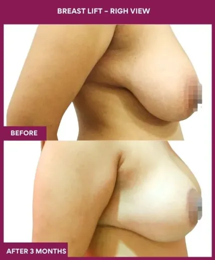 4 Breast Lift – righ View_12