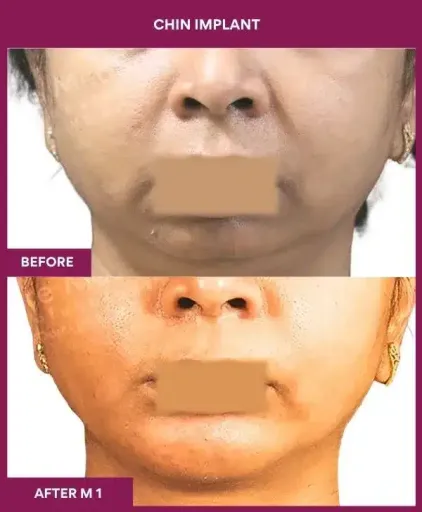 4 Chin Implant in Mumbai, India