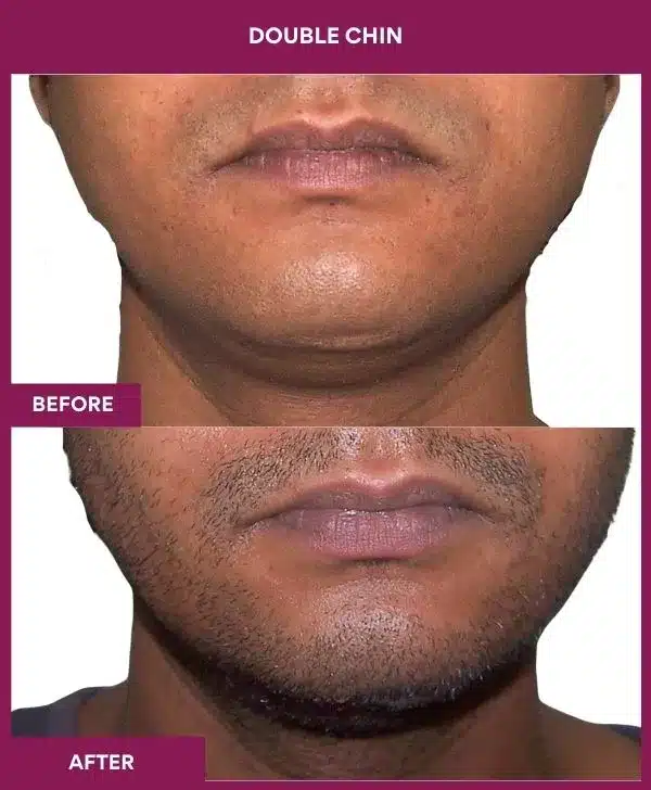 4 Double Chin_57