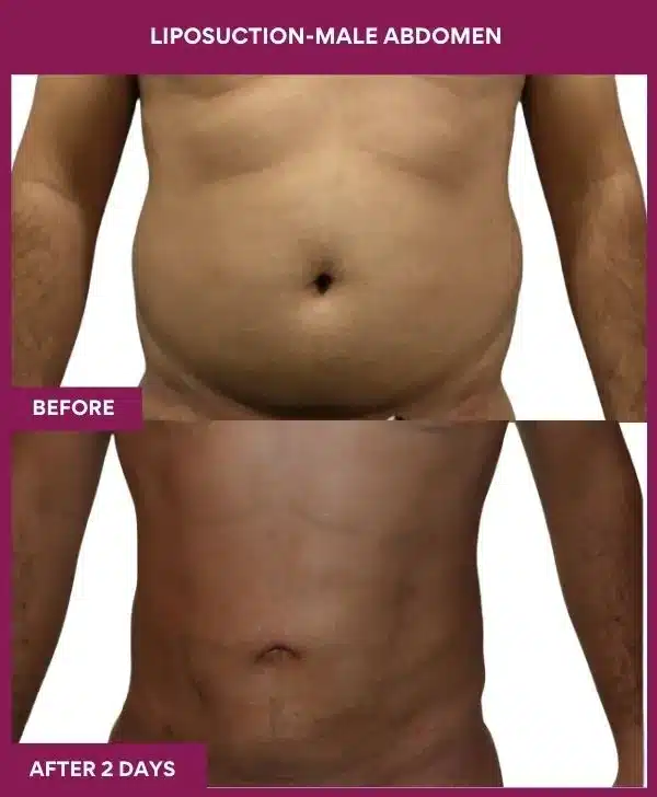 4 LIPOSUCTION-MALE ABDOMEN (3)_10