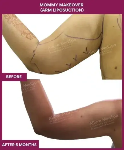 4 Mommy Makeover (Arm Liposuction) (5)