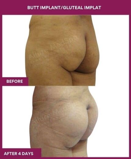5 BUTT IMPLANT_GLUTEAL IMPLAT in Mumbai, India