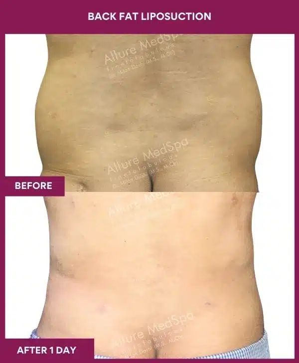 5 Back Fat Liposuction_39
