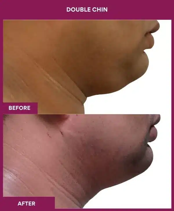 5 Double Chin (3)_58