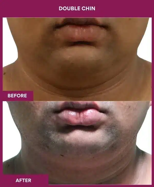 5 Double Chin (4)_58