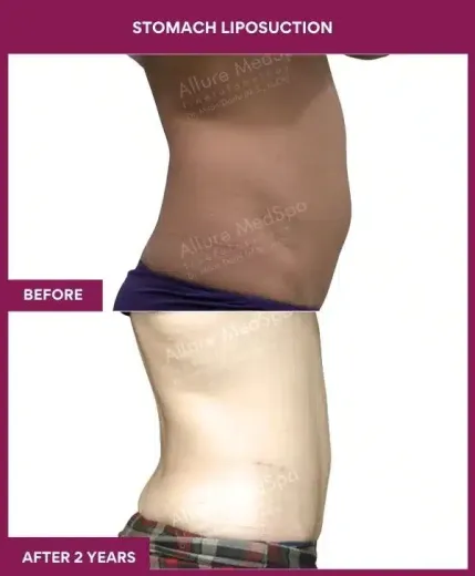 5- Stomach Liposuction-