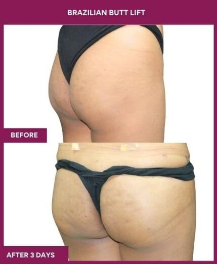 6 Brazilian Butt Lift (3) in Mumbai, India