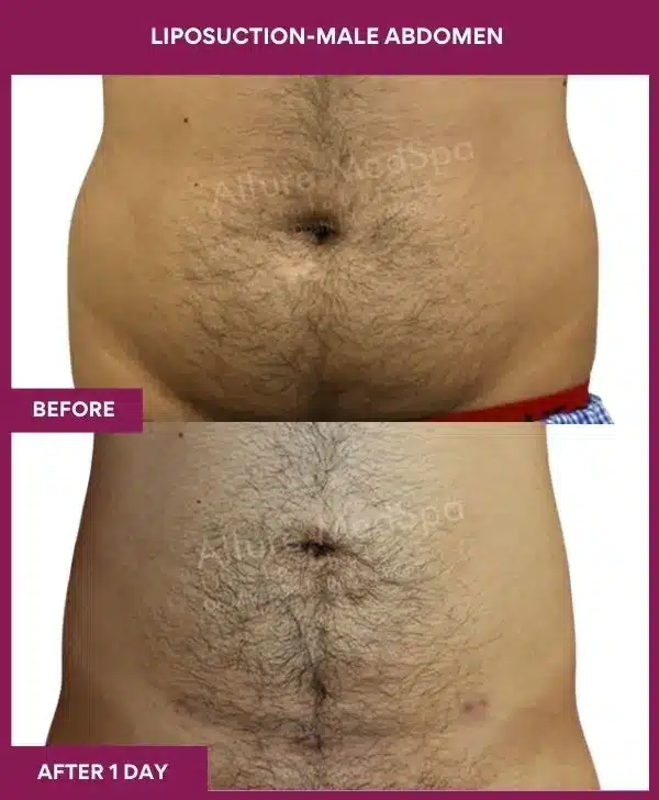 6 LIPOSUCTION-MALE ABDOMEN_14_ (1)