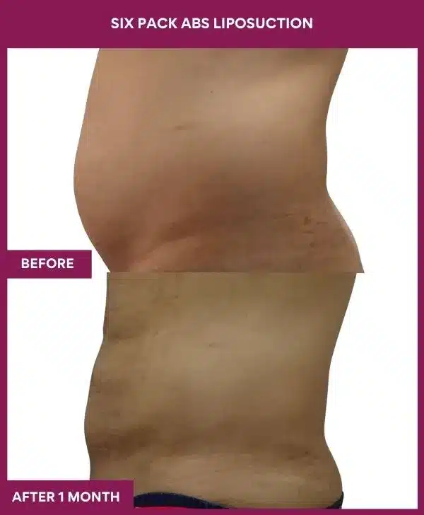 6 Six Pack Abs Liposuction_71 (3)