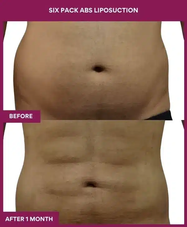 6 Six Pack Abs Liposuction_71 (4)