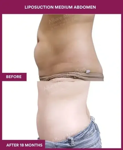 6- liposuction medium abdomen--