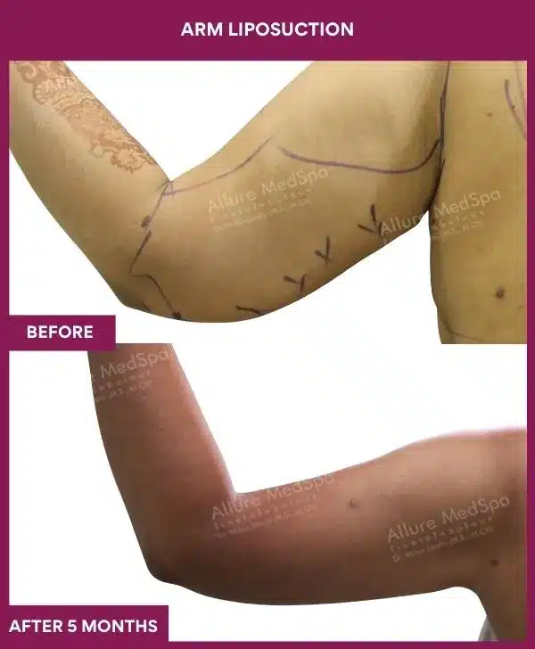 7 Arm Liposuction_31 (2)