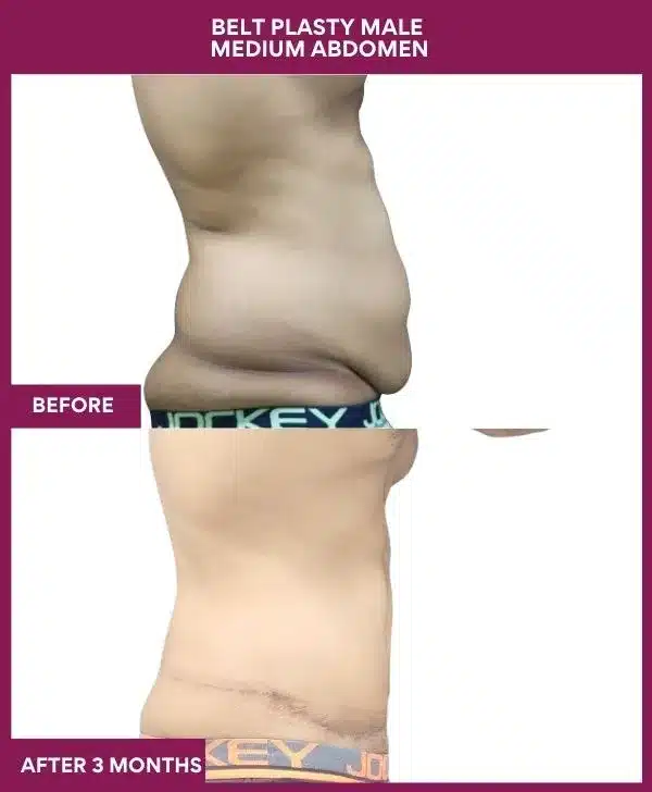 7 BELT PLASTY MALE MEDIUM ABDOMEN (5)_11