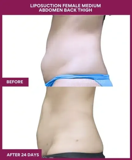 7-LIPOSUCTION FEMALE MEDIUM ABDOMEN BACK THIGH--