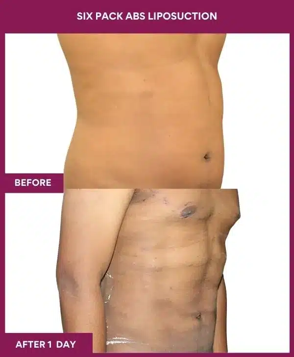 7 Six Pack Abs Liposuction (5)_67