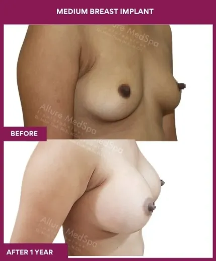 8 MEDIUM BREAST IMPLANT_23_ (2)