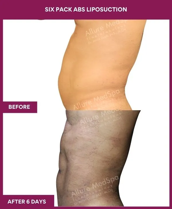 8 Six Pack Abs Liposuction (3)_64