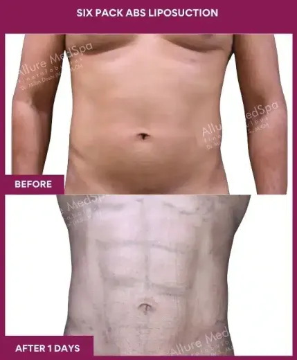 8- Six Pack Abs Liposuction