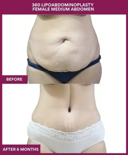 9 360 LIPOABDOMINOPLASTY FEMALE MEDIUM ABDOMEN_27_11zon