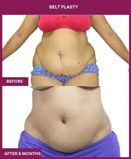 9 BELT PLASTY_15_ (4)