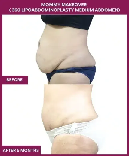 9 Mommy Makeover ( 360 LIPOABDOMINOPLASTY MEDIUM ABDOMEN) (3)_132