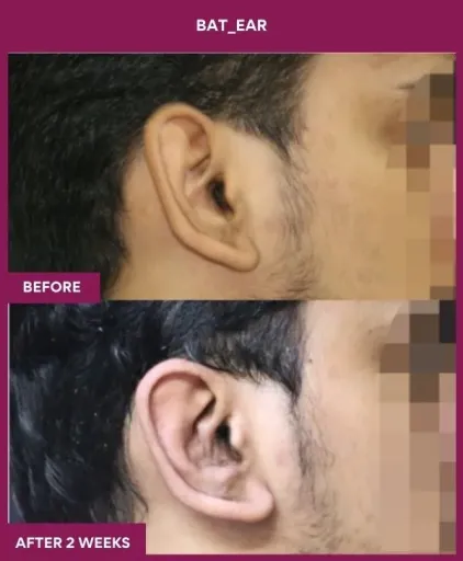 Otoplasty Surgery in Mumbai