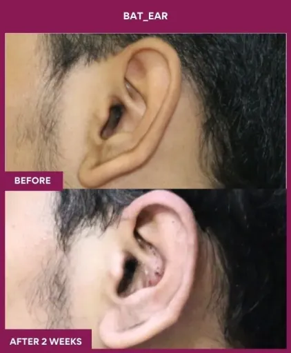 Otoplasty Surgery in Mumbai