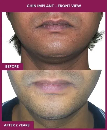 1 Chin Implant – Front View_1