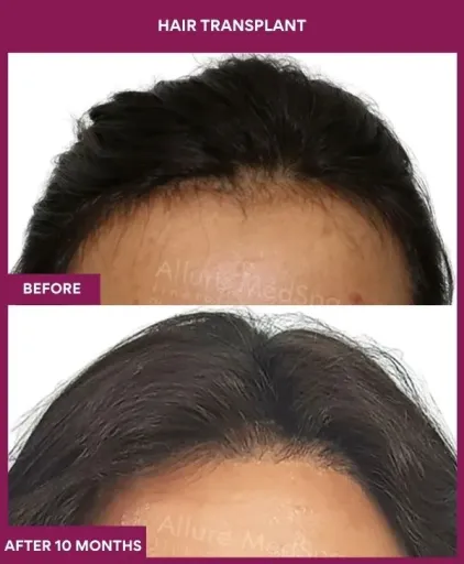 1 FEMALE HAIR LINE_2 (1)