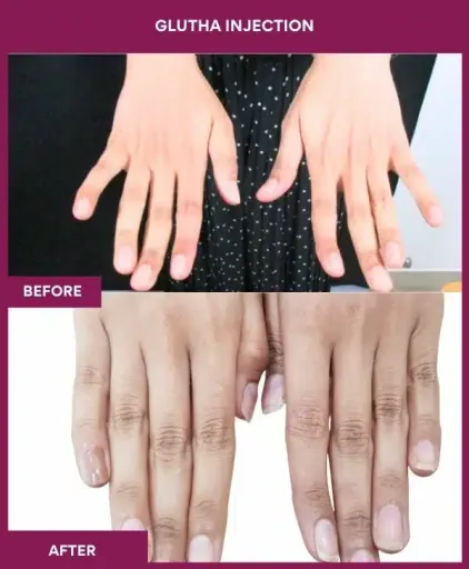 1 Glutha Injection (2)