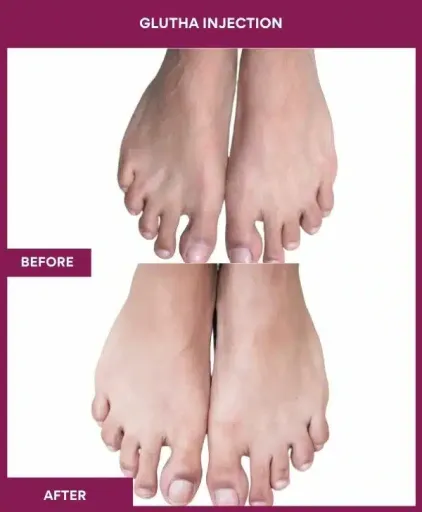 1 Glutha Injection (3)