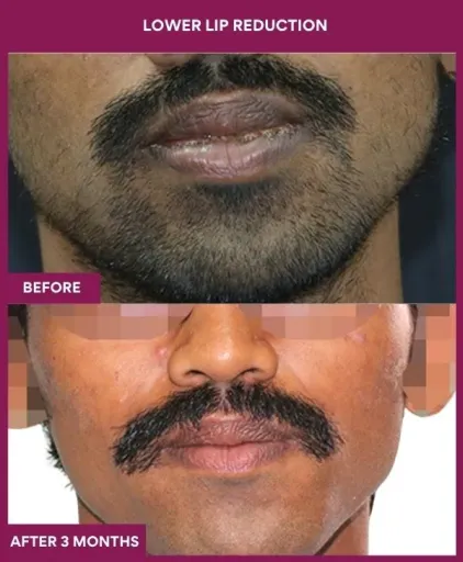 1 LOWER LIP REDUCTION (3)_