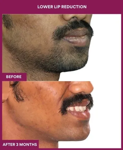 1 LOWER LIP REDUCTION (4)_