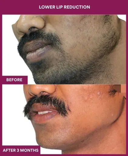 1 LOWER LIP REDUCTION (5)_