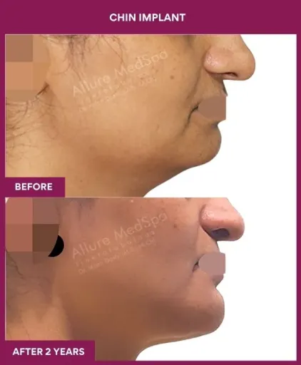 10 Chin Implant_29_ (1)