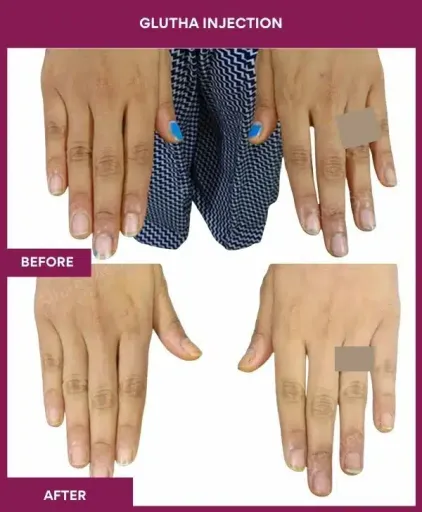 10 Glutha Injection (2)