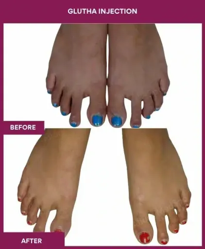 10 Glutha Injection (3)