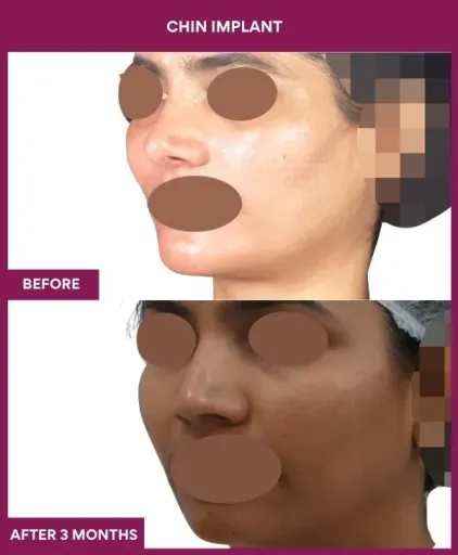 11 Chin Implant (5)_31