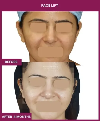 11 FACE LIFT (4)_25_