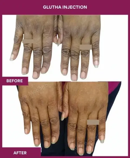 11 Glutha Injection (2)