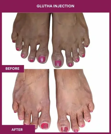 11 Glutha Injection (3)