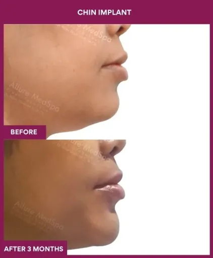 13 Chin Implant (5)_36