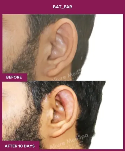 Ear Correction Surgery in Mumbai, India
