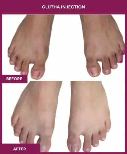 2 Glutha Injection (2)