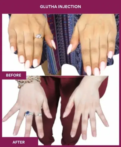 2 Glutha Injection (3)