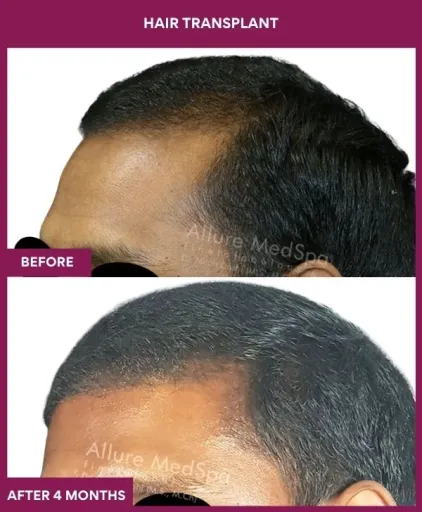 2 Hair Transplant (3)_4_